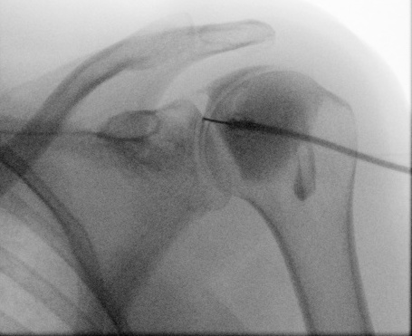 CAPSULODISTENSION ARTICULAIRE DE L'EPAULE - 25 radiologues à ...