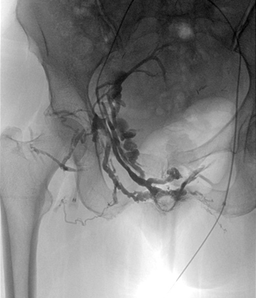 varices pelviennes symptômes