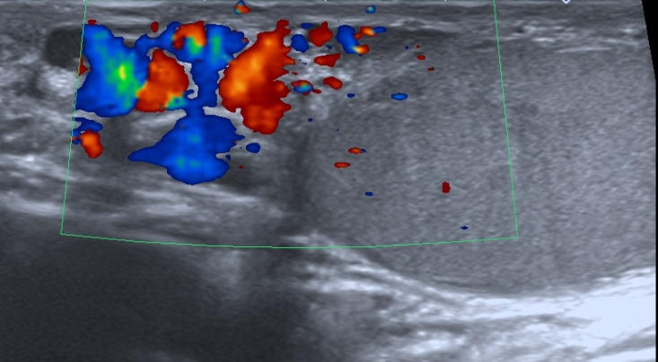 EMBOLISATION DE VARICOCELE CHEZ L'HOMME - 25 radiologues à ...